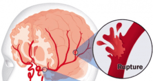 Rising stroke prevalence has financial impact on healthcare, society