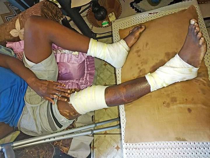 physiotherapy